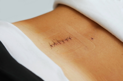 back surgery recovery
