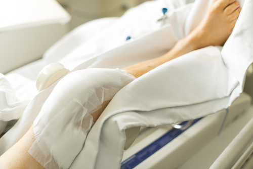 Typical MCL Surgery Recovery Timeline