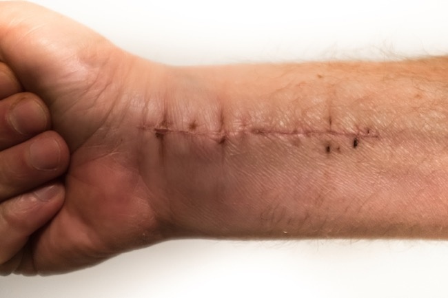 4_Ways_to_Prepare_for_Wrist_Surgery_Recovery