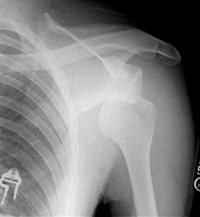 dislocated should